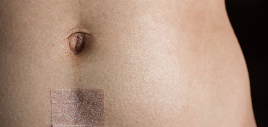 Plastic Surgery After Having a C-section