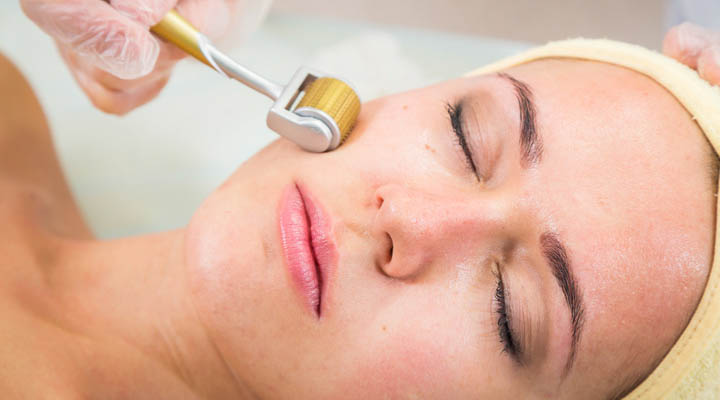 Microneedling and You