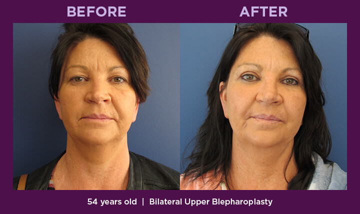 WMD528645_CosmeticUpperBlepharoplasty1